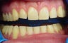 teeth whitening and dental veneers 