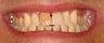 Tooth bleaching and porcelain veneer