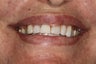Porcelain Bridge and Veneers