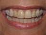 Veneers #7-10