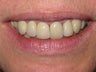 Dental Crown