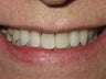 Veneers and Whitening