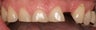 Porcelain Veneers