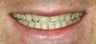  Porcelain veneer therapy