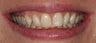 Porcelain Veneers