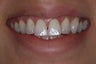 Two central incisor porcelain veneers