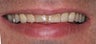 Veneers along with crowns
