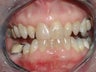 Porcelain Veneers