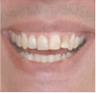 Porcelain Veneers