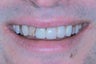 Crowns and Veneers