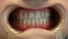 Upper arch make over with veneers and crowns
