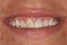 Simple Smile Design with gum lift and porcelain veneers