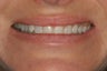 Smile Makeover with Minimal-Prep and No-Prep Veneers