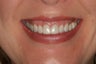 Smile Makeover: Porcelain Veneers
