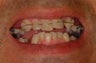 Complete  Smile Makeover