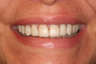  Porcelain Veneers Smile Makeover