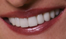 Porcelain Veneers