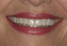 Porcelain Veneers