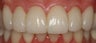 Porcelain Veneers