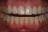 Veneers