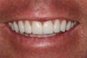 Porcelain Veneers/ Smile Makeover