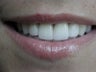 Porcelain Veneers
