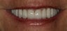 Smile Makeover
