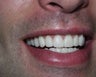 Veneers