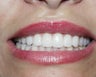 Porcelain Veneers