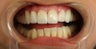 porcelain veneers