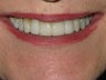 Veneers