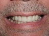 Porcelain Veneers