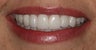 Porcelain Veneers
