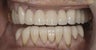 Porcelain Veneers