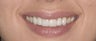 porcelain veneers