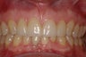 Porcelain Veneers four front teeth