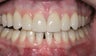 Replacement Porcelain Veneers