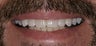 Porcelain veneers