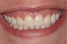 Empress Porcelain Teeth Veneers