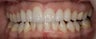 Porcelain Veneers