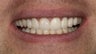Porcelain Bridge and Veneer