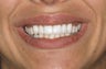 Veneers