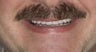 Porcelain Crowns and Veneer