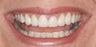 Porcelain Veneers