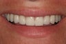 Porcelain Veneers