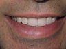 Teeth whitening and veneers