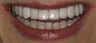 Porcelain veneers and whitening