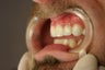porcelain bridge with veneers replacing teeth