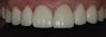 Porcelain Veneers