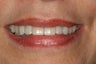 Porcelain crowns and porcelain veneers